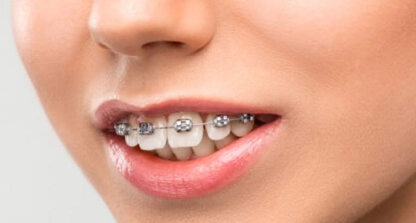 how-to-fix-an-overbite-with-braces-transits-blog