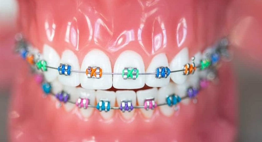 what-braces-color-is-right-for-you